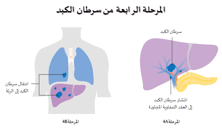 المرحلة الرابعة من سرطان الكبد